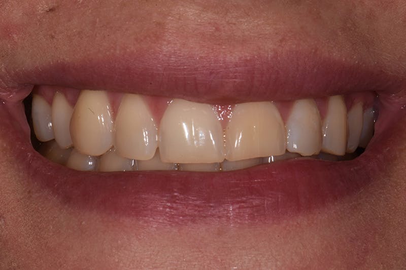 Patient Smile Before & After Gallery - Patient 157410 - Image 3