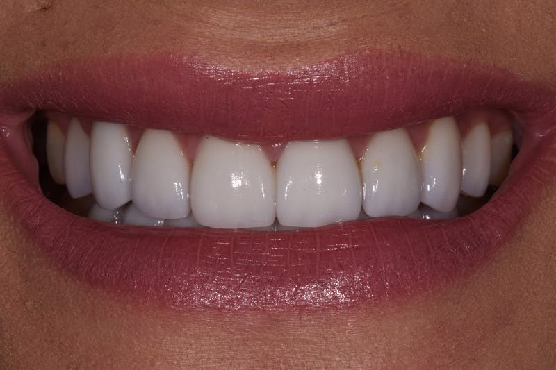 Patient Smile Before & After Gallery - Patient 157410 - Image 4