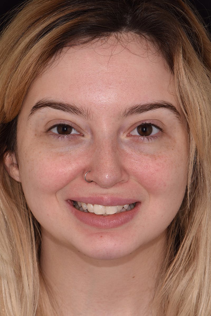 Patient Smile Before & After Gallery - Patient 415399 - Image 1