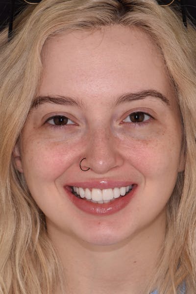 Patient Smile Before & After Gallery - Patient 415399 - Image 2