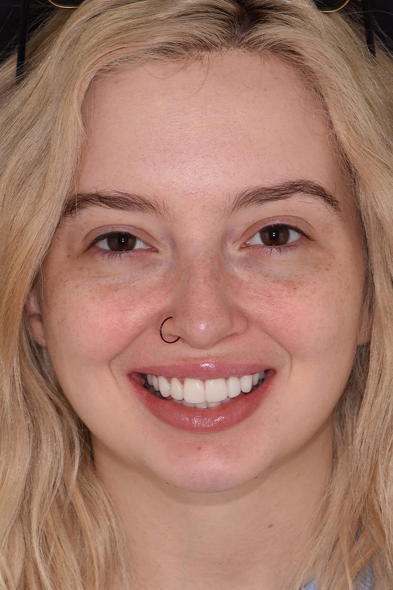 Patient Smile Before & After Gallery - Patient 415399 - Image 2