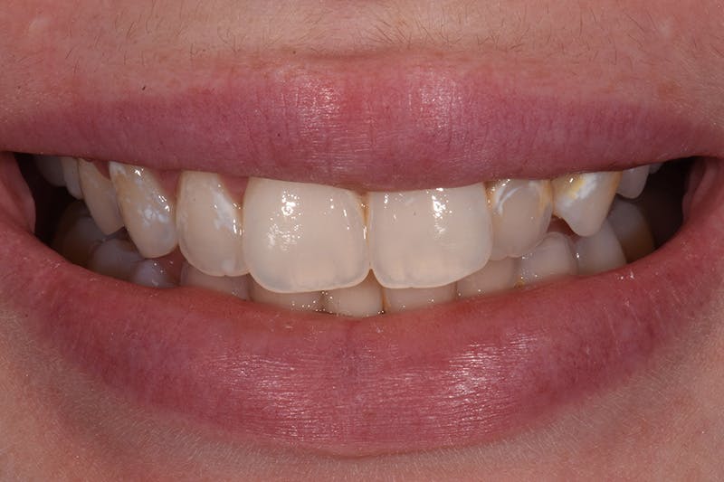 Patient Smile Before & After Gallery - Patient 415399 - Image 3