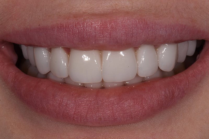 Patient Smile Before & After Gallery - Patient 415399 - Image 4