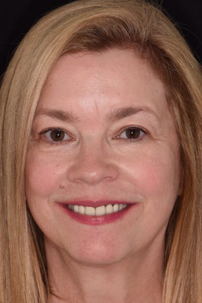 Patient Smile Before & After Gallery - Patient 163384 - Image 1
