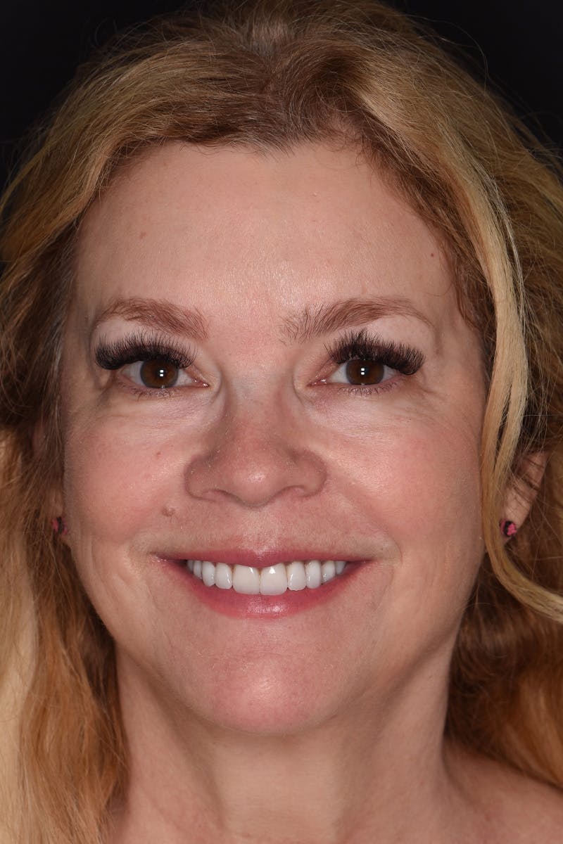 Patient Smile Before & After Gallery - Patient 163384 - Image 2