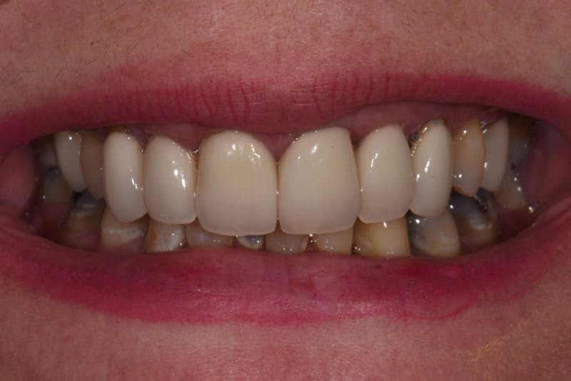 Patient Smile Before & After Gallery - Patient 163384 - Image 3