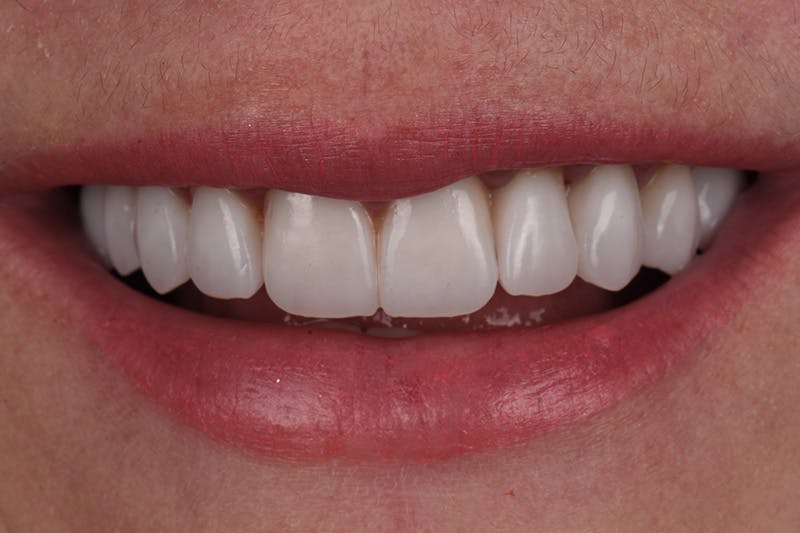 Patient Smile Before & After Gallery - Patient 163384 - Image 4
