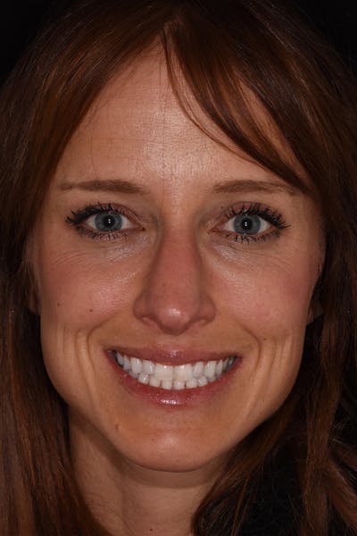 Patient Smile Before & After Gallery - Patient 135446 - Image 1