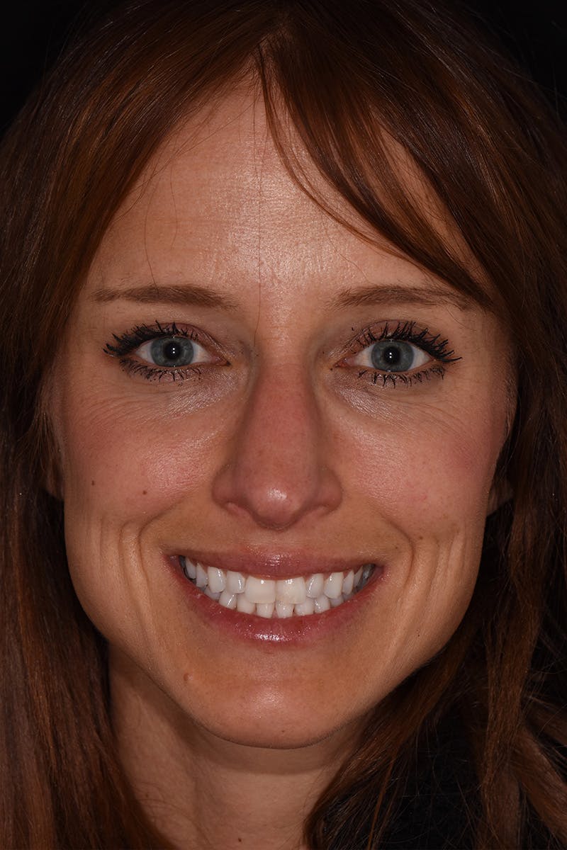 Patient Smile Before & After Gallery - Patient 135446 - Image 1