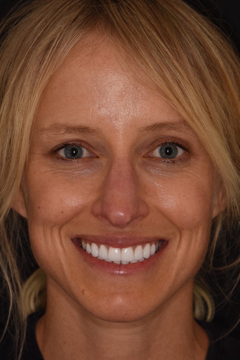 Patient Smile Before & After Gallery - Patient 135446 - Image 2