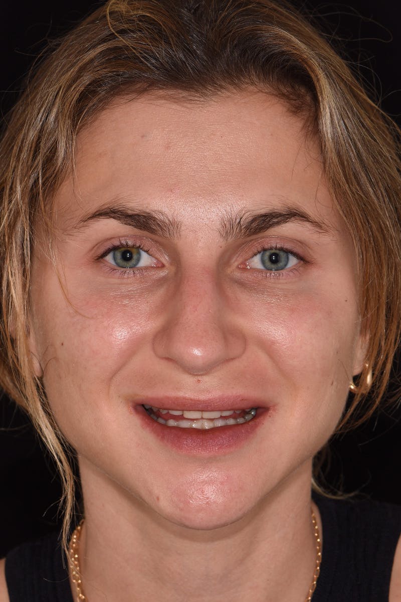 Patient Smile Before & After Gallery - Patient 248367 - Image 1