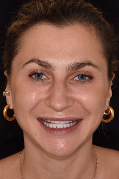 Patient Smile Before & After Gallery - Patient 248367 - Image 2