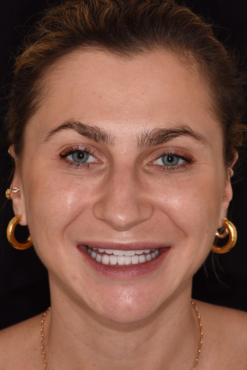 Patient Smile Before & After Gallery - Patient 248367 - Image 2