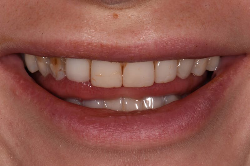 Patient Smile Before & After Gallery - Patient 248367 - Image 3