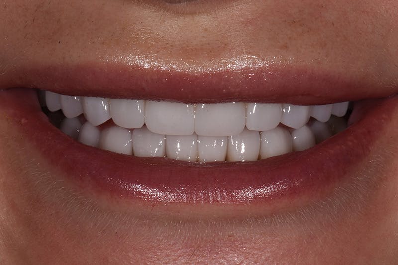 Patient Smile Before & After Gallery - Patient 248367 - Image 4