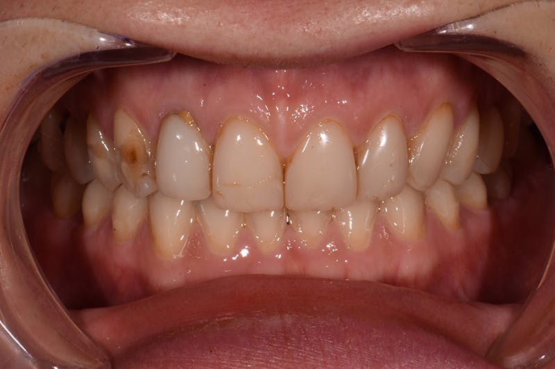 Patient Smile Before & After Gallery - Patient 248367 - Image 5