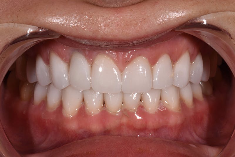 Patient Smile Before & After Gallery - Patient 248367 - Image 6