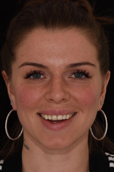 Patient Smile Before & After Gallery - Patient 857839 - Image 1