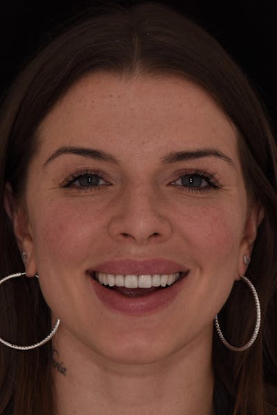 Patient Smile Before & After Gallery - Patient 857839 - Image 2