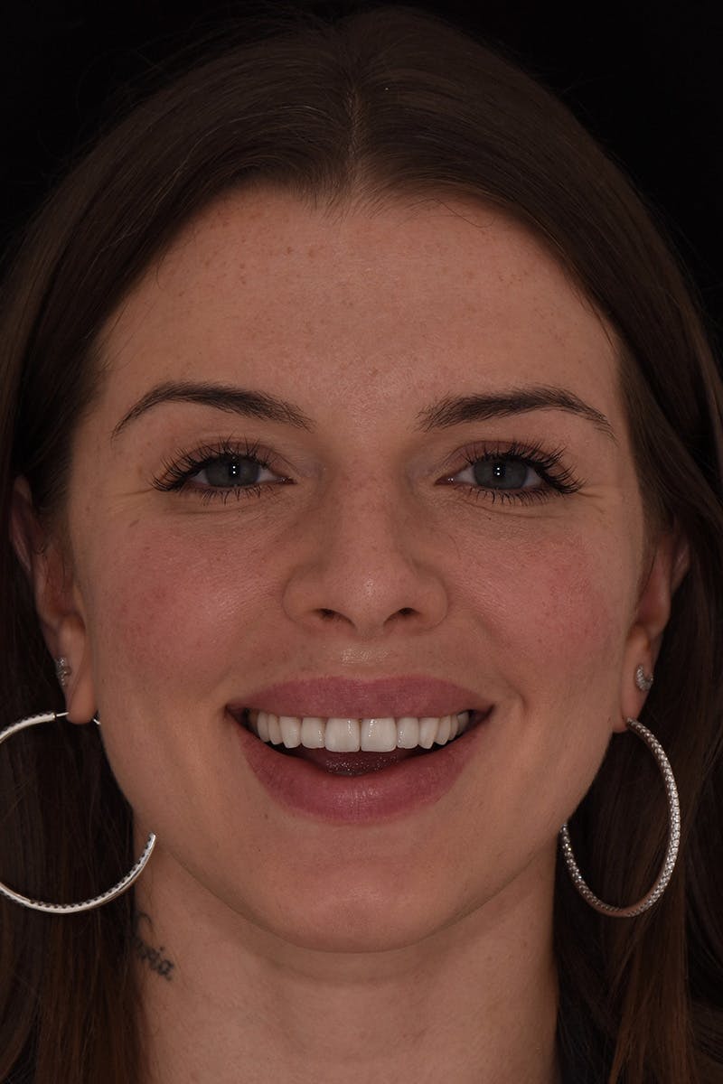 Patient Smile Before & After Gallery - Patient 857839 - Image 2