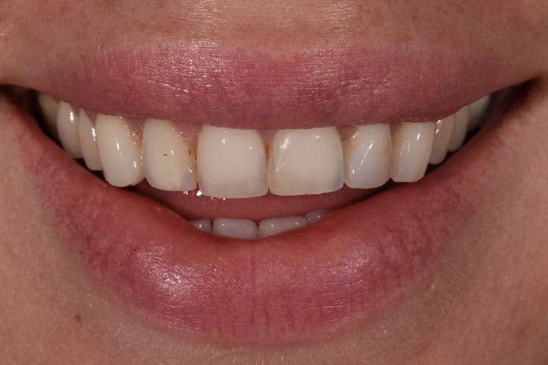 Patient Smile Before & After Gallery - Patient 857839 - Image 3