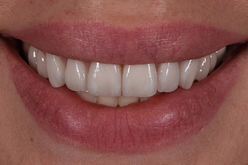 Patient Smile Before & After Gallery - Patient 857839 - Image 4