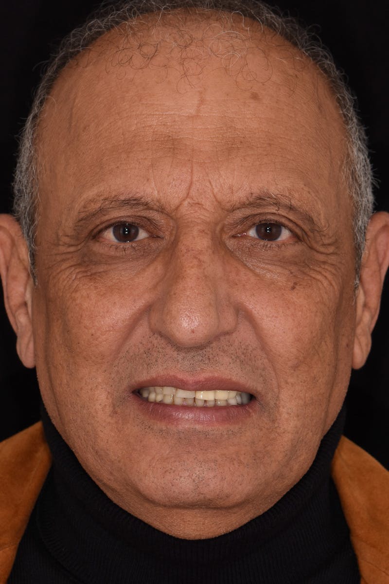 Patient Smile Before & After Gallery - Patient 209843 - Image 1