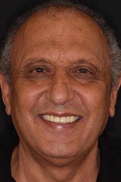 Patient Smile Before & After Gallery - Patient 209843 - Image 2