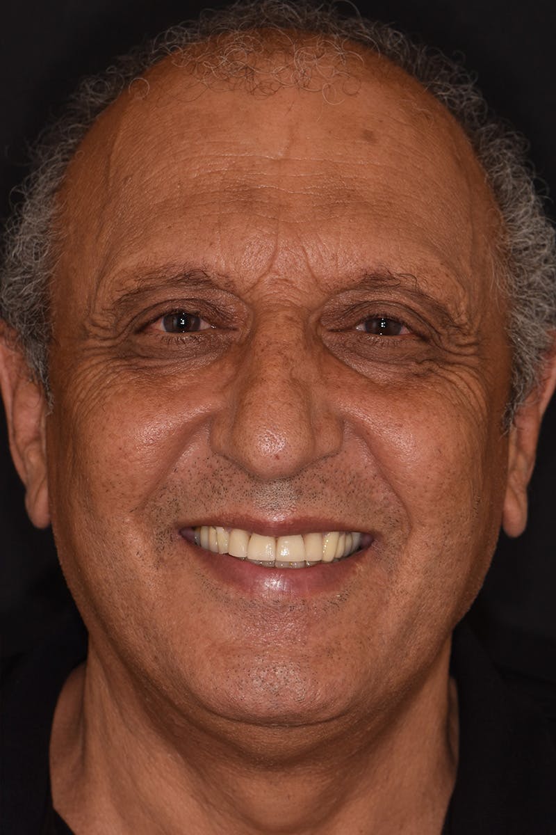 Patient Smile Before & After Gallery - Patient 209843 - Image 2
