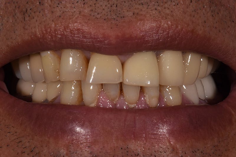Patient Smile Before & After Gallery - Patient 209843 - Image 3