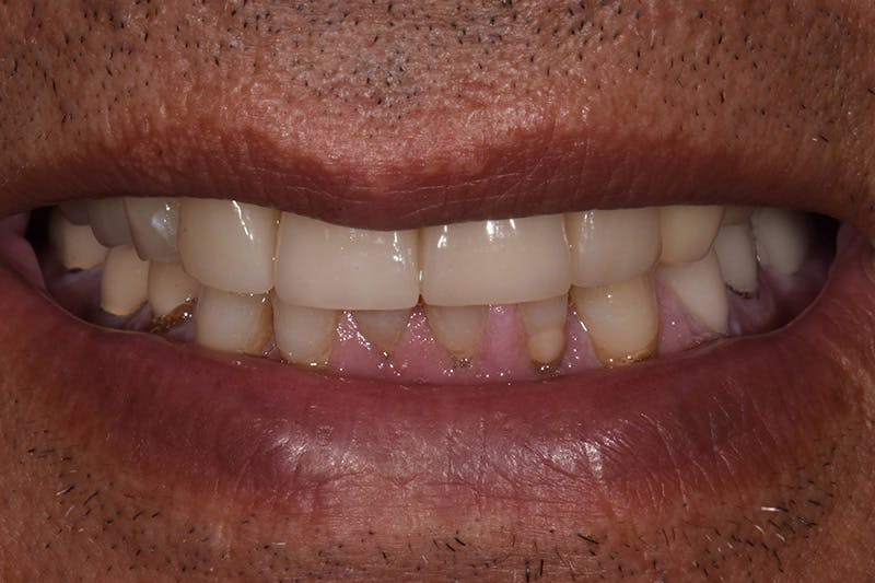 Patient Smile Before & After Gallery - Patient 209843 - Image 4