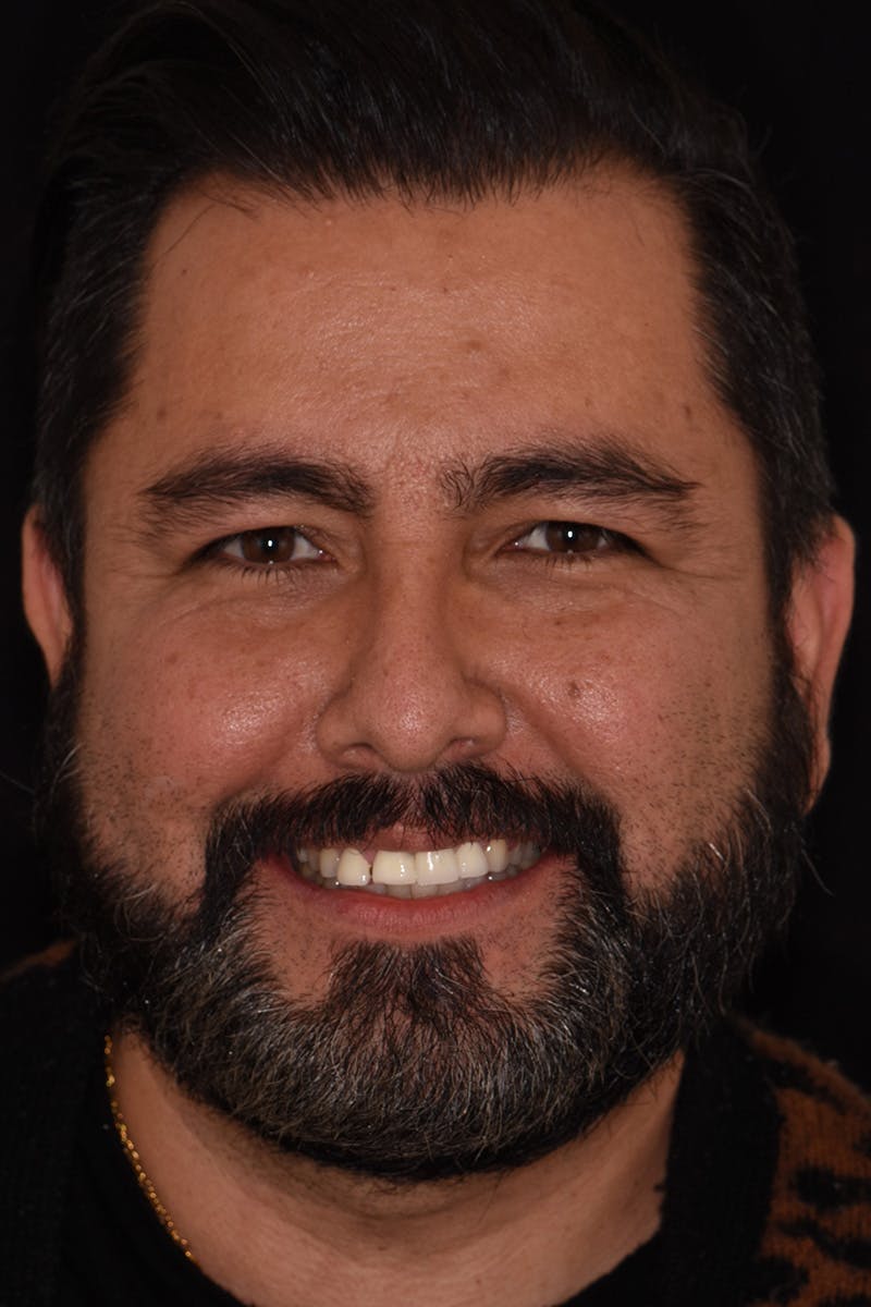 Patient Smile Before & After Gallery - Patient 181567 - Image 1