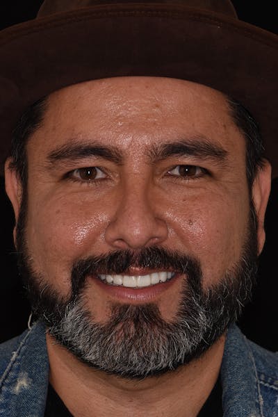 Patient Smile Before & After Gallery - Patient 181567 - Image 2