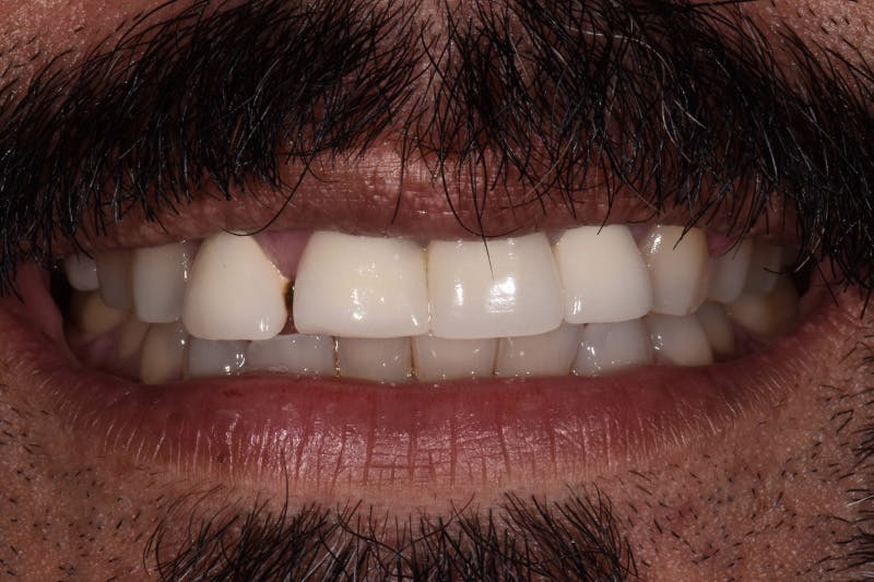 Patient Smile Before & After Gallery - Patient 181567 - Image 3