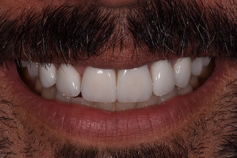 Patient Smile Before & After Gallery - Patient 181567 - Image 4