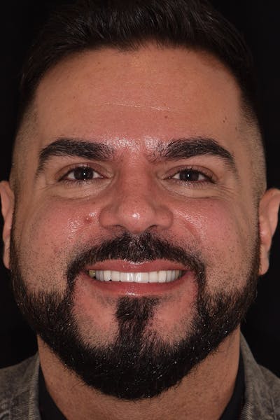 Patient Smile Before & After Gallery - Patient 206946 - Image 2