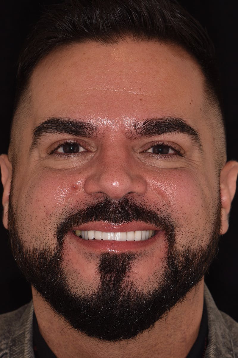 Patient Smile Before & After Gallery - Patient 206946 - Image 2