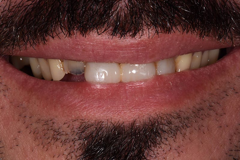 Patient Smile Before & After Gallery - Patient 206946 - Image 3