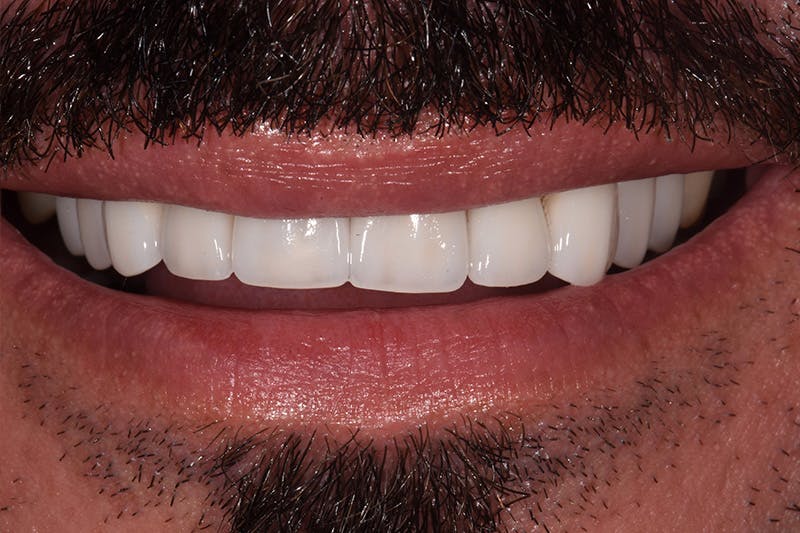 Patient Smile Before & After Gallery - Patient 206946 - Image 4
