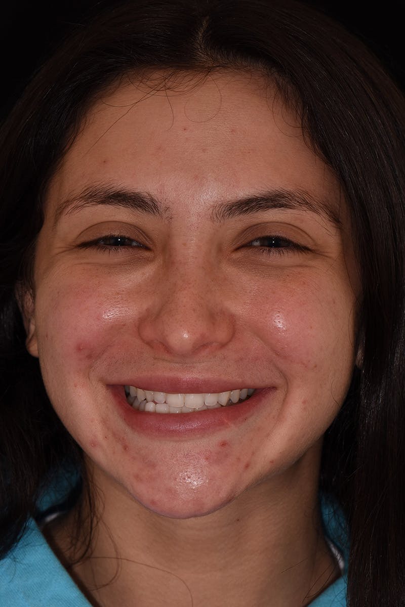 Patient Smile Before & After Gallery - Patient 602844 - Image 1