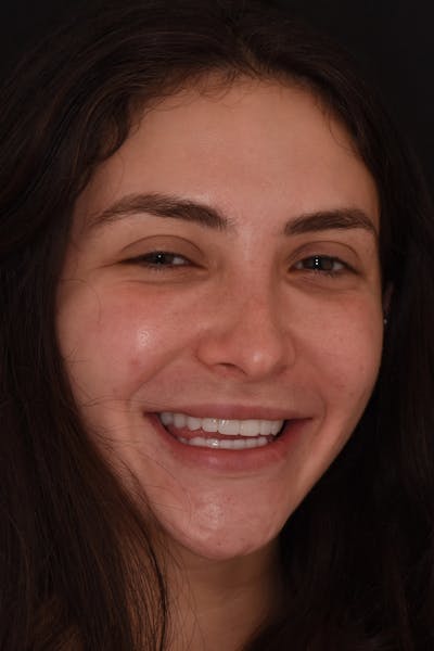Patient Smile Before & After Gallery - Patient 602844 - Image 2