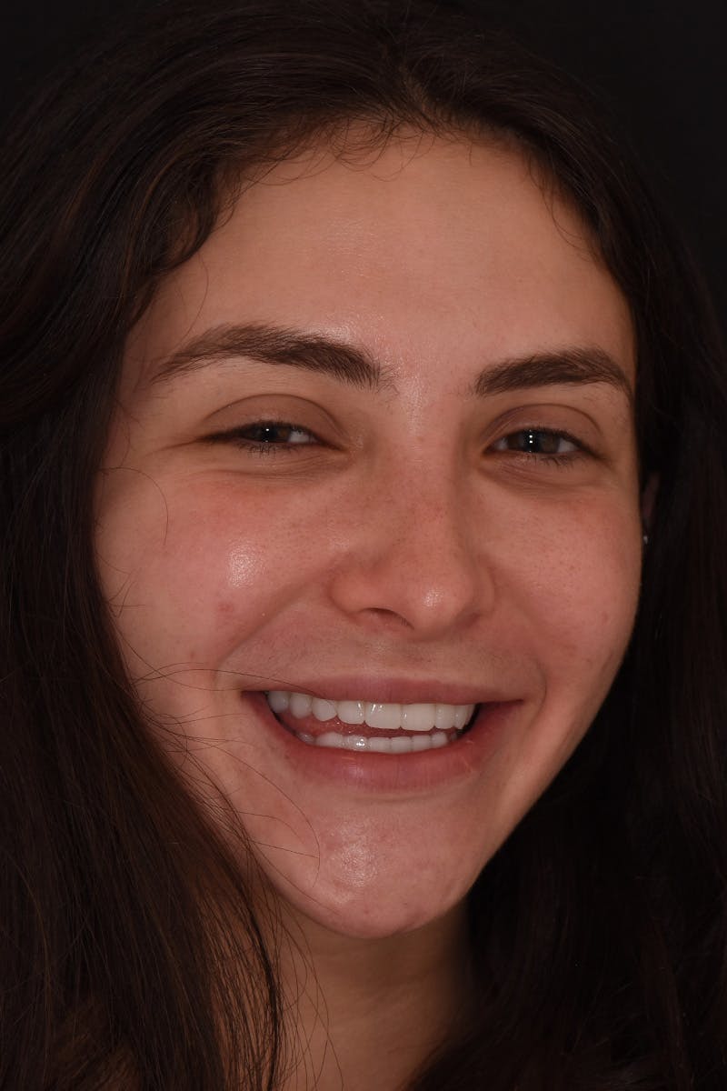 Patient Smile Before & After Gallery - Patient 602844 - Image 2