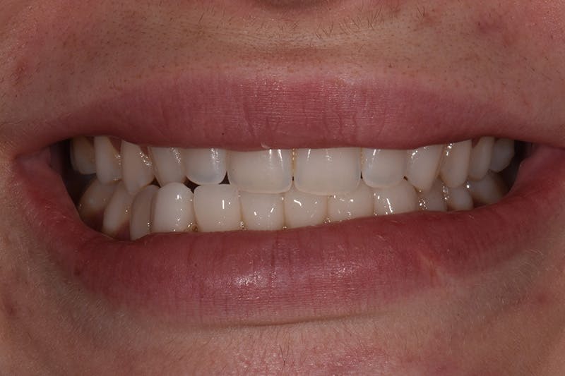 Patient Smile Before & After Gallery - Patient 602844 - Image 3