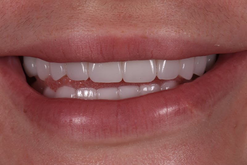 Patient Smile Before & After Gallery - Patient 602844 - Image 4