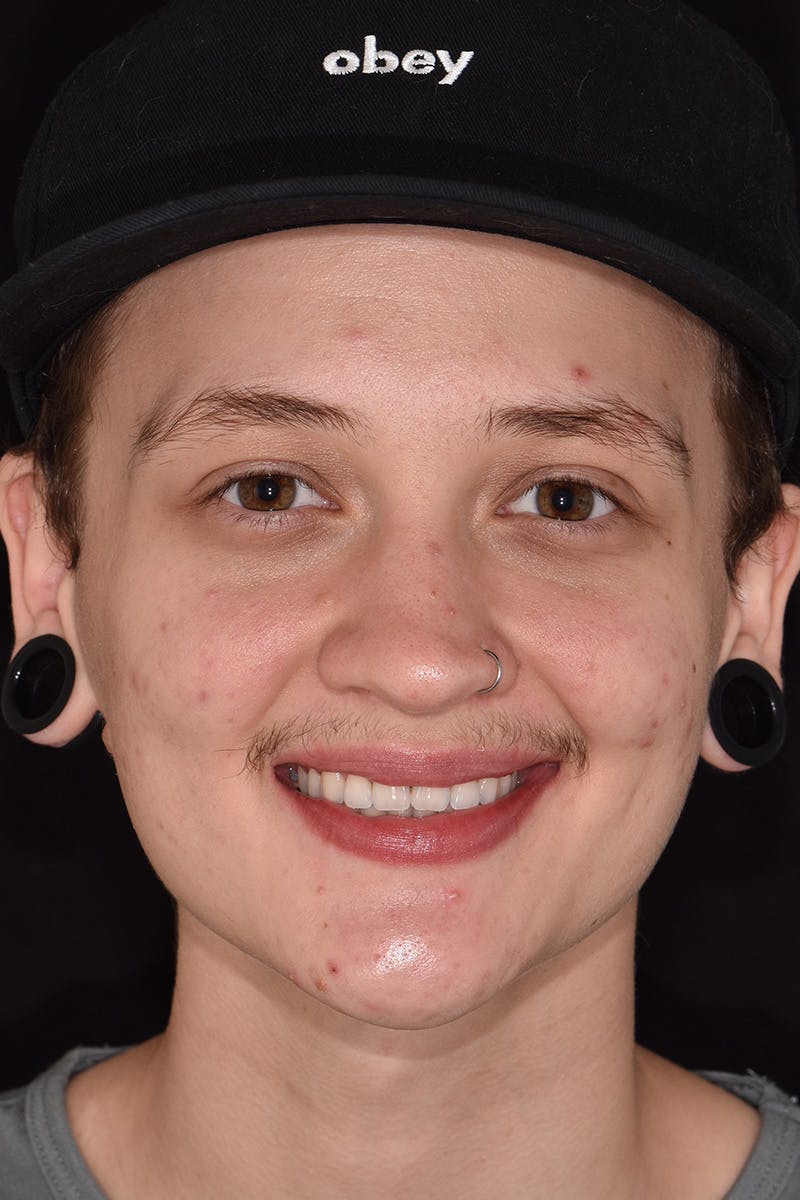 Patient Smile Before & After Gallery - Patient 589503 - Image 1