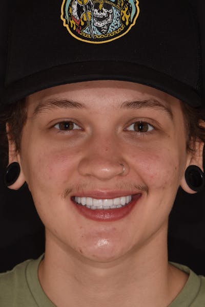 Patient Smile Before & After Gallery - Patient 589503 - Image 2