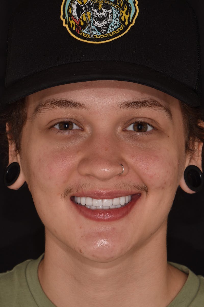 Patient Smile Before & After Gallery - Patient 589503 - Image 2