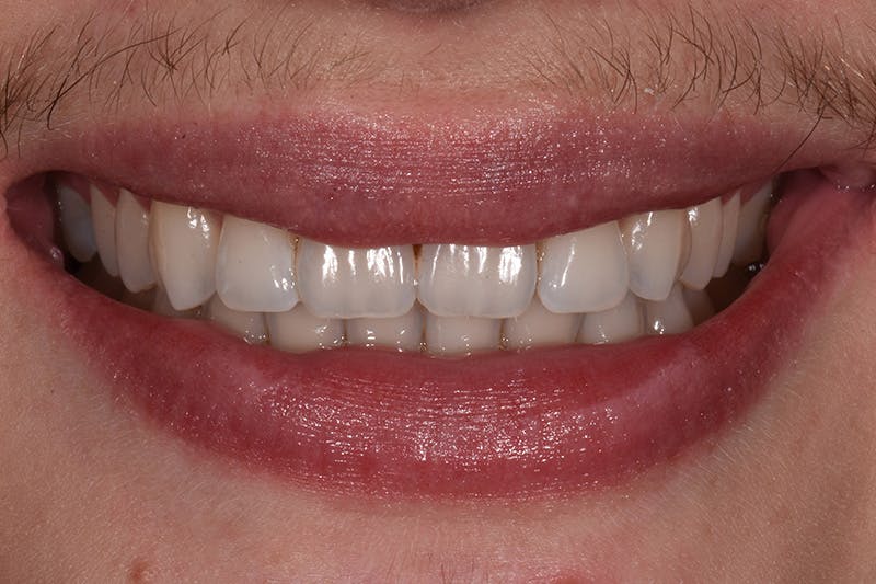 Patient Smile Before & After Gallery - Patient 589503 - Image 3