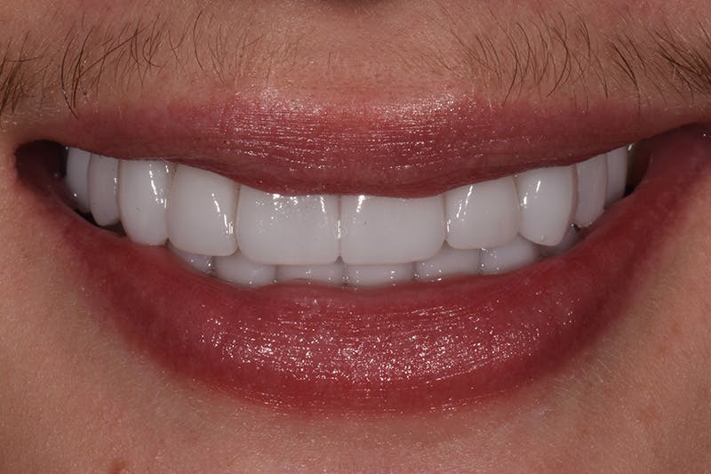 Patient Smile Before & After Gallery - Patient 589503 - Image 4