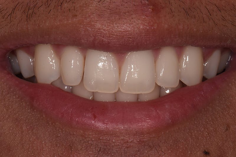 Patient Smile Before & After Gallery - Patient 242758 - Image 3